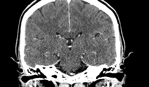 File:Active neurocysticercosis before and after therapy (Radiopaedia 71710-82099 Coronal 4).jpg