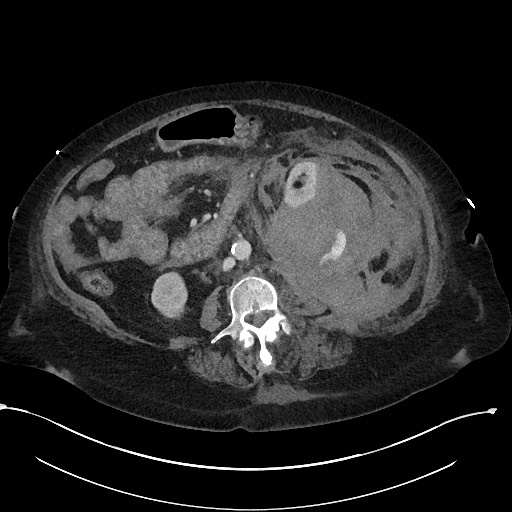 File:Active renal extravasation with large subcapsular and retroperitoneal hemorrhage (Radiopaedia 60975-68796 Axial 243).jpg