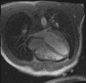 Active right ventricular cardiac sarcoidosis (Radiopaedia 55596-62100 Axial Dynamic perfusion scan MOCO 100).jpg