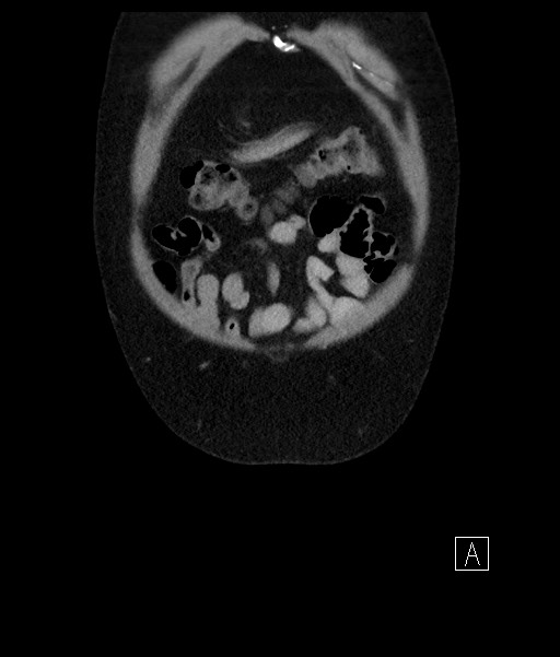 Acute-on-chronic pancreatitis (Radiopaedia 67286-76656 Coronal C+ portal venous phase 14).jpg
