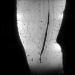 Acute-on-chronic transient lateral patellar dislocation with trochlear dysplasia (Radiopaedia 84099-99349 Sagittal PD 2).jpg
