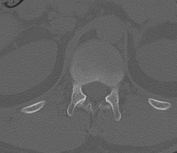 File:Acute L1 burst compression fracture (Radiopaedia 34430-35755 Axial bone window 7).png
