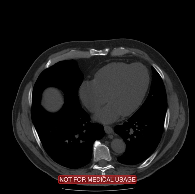 Acute aortic dissection - Stanford type A (Radiopaedia 40661-43285 Axial non-contrast 44).jpg