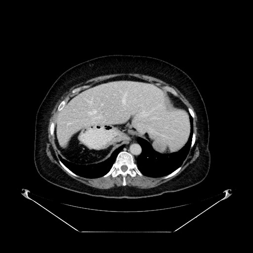 Acute appendicitis, heterotaxy syndrome (Radiopaedia 66884-76202 Axial C+ portal venous phase 26).jpg