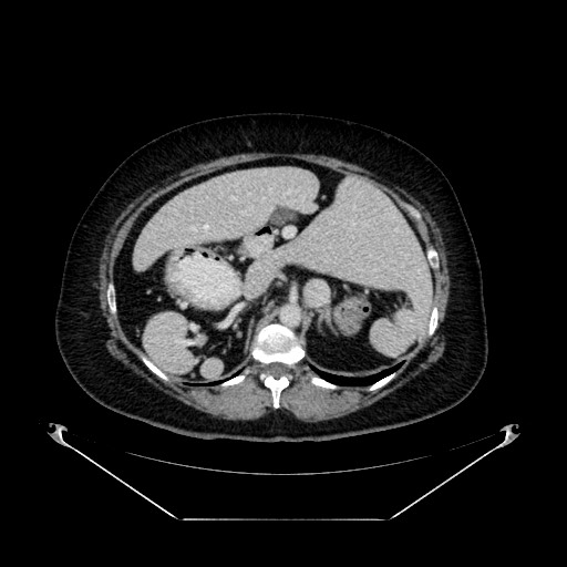 Acute appendicitis, heterotaxy syndrome (Radiopaedia 66884-76202 Axial C+ portal venous phase 39).jpg