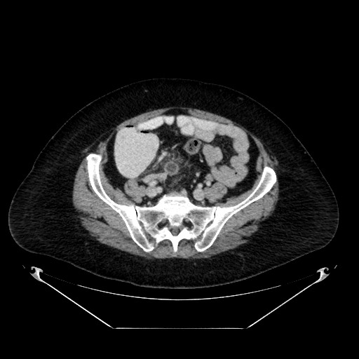 Acute appendicitis, heterotaxy syndrome (Radiopaedia 66884-76202 Axial C+ portal venous phase 94).jpg