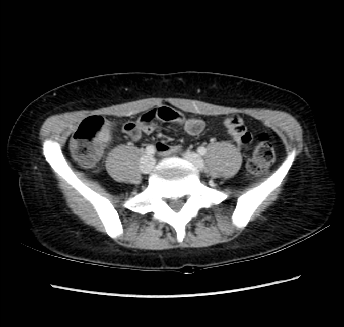 Acute appendicitis (Radiopaedia 22892-22918 Axial C+ portal venous phase 56).png