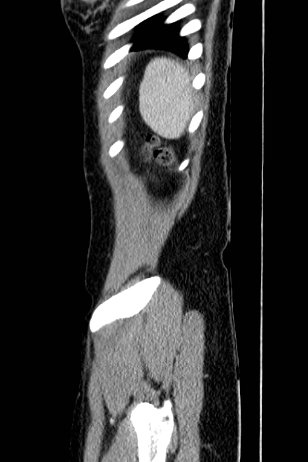 Acute appendicitis (Radiopaedia 22892-22918 Sagittal C+ portal venous phase 81).png