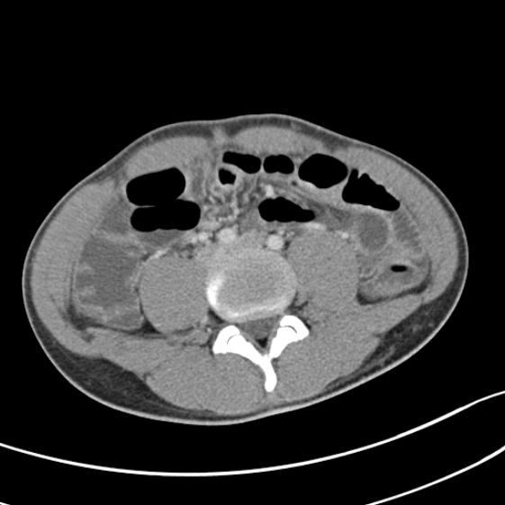 File:Acute appendicitis (Radiopaedia 32614-33572 Axial C+ portal venous phase 40).jpg
