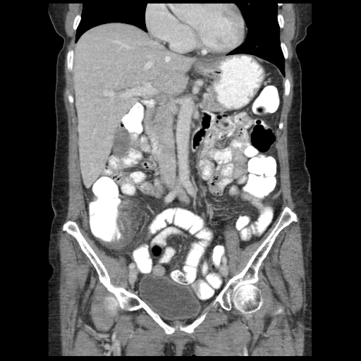 File:Acute appendicitis (Radiopaedia 52672-58589 Coronal C+ portal venous phase 42).jpg