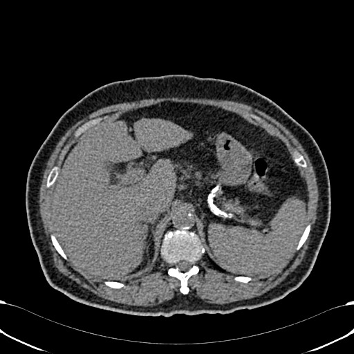 File:Acute appendicitis (Radiopaedia 58627-65818 Axial non-contrast 23).jpg