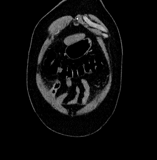 Acute appendicitis (Radiopaedia 79950-93224 Coronal C+ portal venous phase 5).jpg