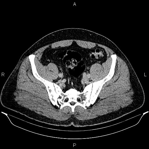 Acute appendicitis (Radiopaedia 84780-100240 Axial C+ portal venous phase 87).jpg