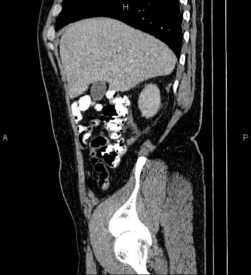 Acute appendicitis (Radiopaedia 84780-100240 Sagittal C+ portal venous phase 20).jpg
