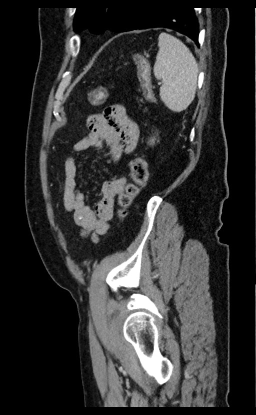 Acute appendicitis - large appendicoliths (Radiopaedia 61805-69820 Sagittal C+ portal venous phase 21).jpg