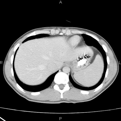 File:Acute appendicitis with CT arrowhead sign (Radiopaedia 21474-21411 Axial C+ portal venous phase 4).jpg