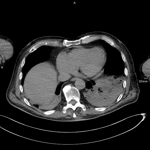 Acute aspiration pneumonitis (Radiopaedia 55642-62166 Axial liver window 48).jpg