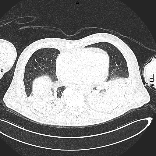 File:Acute aspiration pneumonitis (Radiopaedia 55642-62166 Axial lung window 108).jpg