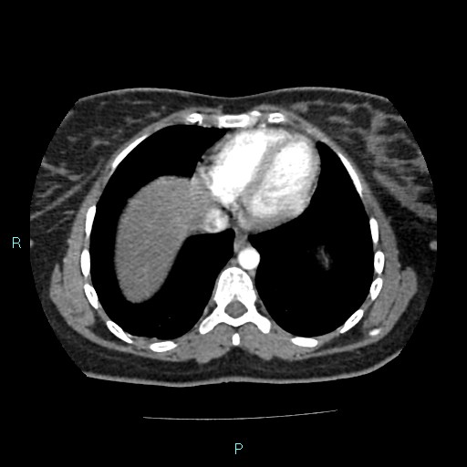 File:Acute bilateral pyelonephritis (Radiopaedia 37146-38881 Axial C+ arterial phase 4).jpg