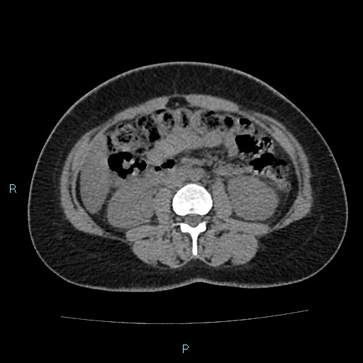 Acute bilateral pyelonephritis (Radiopaedia 37146-38881 Axial non-contrast 52).jpg