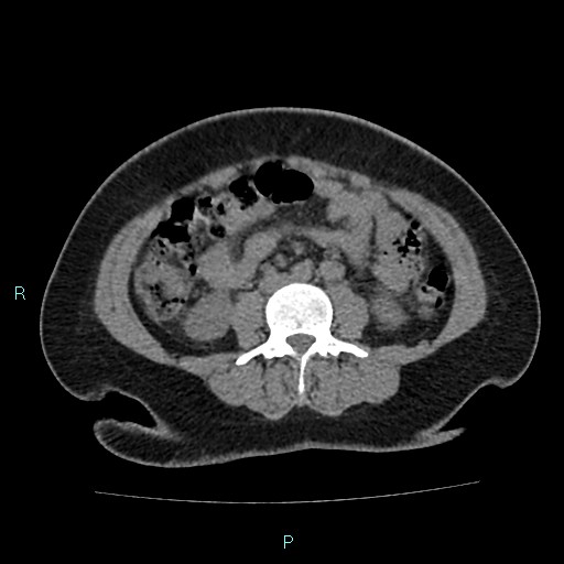 Acute bilateral pyelonephritis (Radiopaedia 37146-38881 Axial non-contrast 58).jpg