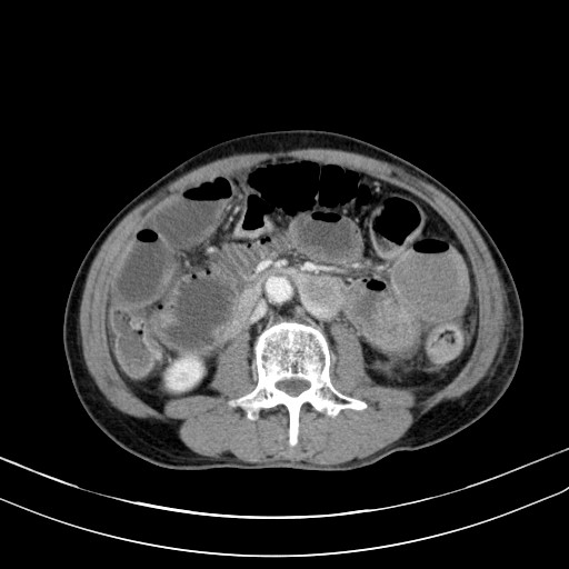 Acute bowel ischemia (Radiopaedia 87695-104114 Axial C+ portal venous phase 43).jpg