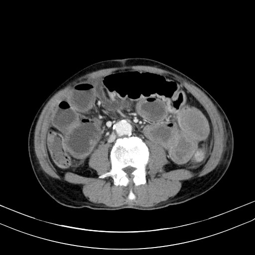 Acute bowel ischemia (Radiopaedia 87695-104114 Axial C+ portal venous phase 48).jpg