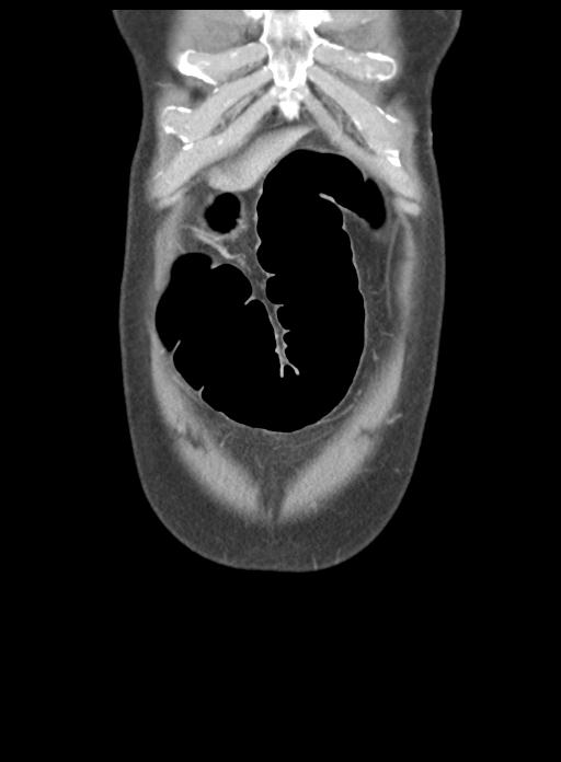 Acute cholecystitis (Radiopaedia 29814-30327 Coronal C+ portal venous phase 8).jpg