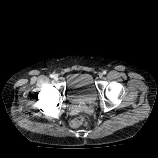 File:Acute cholecystitis and incidental left sided IVC (Radiopaedia 49352-54459 Axial C+ portal venous phase 147).jpg