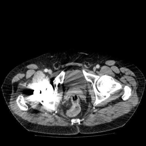 File:Acute cholecystitis and incidental left sided IVC (Radiopaedia 49352-54459 Axial C+ portal venous phase 151).jpg