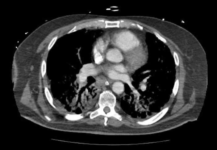 Acute cor pulmonale (ultrasound) (Radiopaedia 83508-98818 Axial C+ CTPA 41).jpg