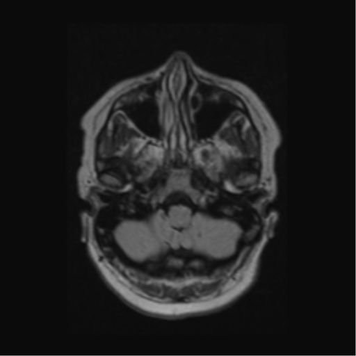 Acute disseminated encephalomyelitis (ADEM) (Radiopaedia 38073-40065 Axial FLAIR 7).png