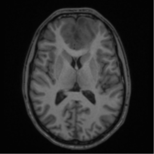 Acute disseminated encephalomyelitis (ADEM) (Radiopaedia 65319-74349 Axial T1 35).png
