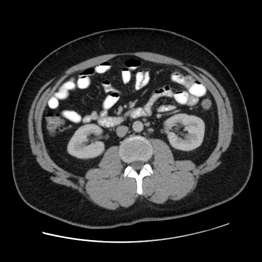 File:Acute diverticulitis with localized perforation (Radiopaedia 41296-44113 Axial C+ portal venous phase 43).jpg