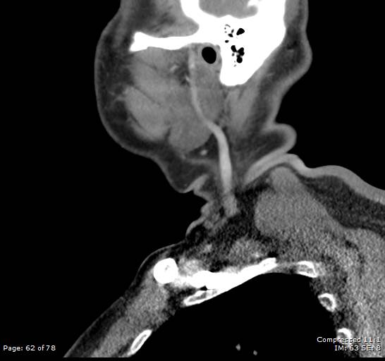 Acute epiglottitis (Radiopaedia 54375-60590 Sagittal C+ arterial phase 62).jpg