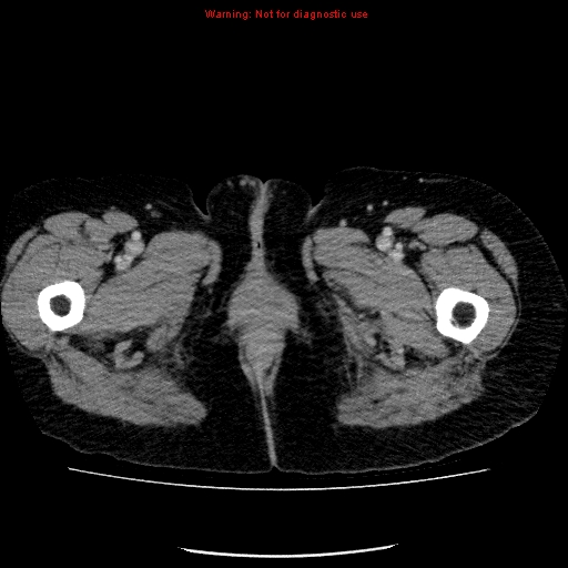 Acute gangrenous cholecystitis (Radiopaedia 10123-10661 Axial C+ portal venous phase 113).jpg