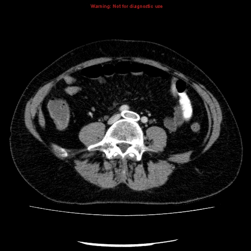 File:Acute gangrenous cholecystitis (Radiopaedia 10123-10661 Axial C+ portal venous phase 67).jpg