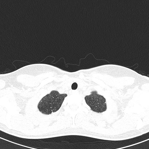 File:Acute hypersensitivity pneumonitis (Radiopaedia 85293-100870 Axial lung window 6).jpg