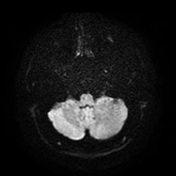 Acute internal carotid artery dissection (Radiopaedia 53541-59632 Axial DWI 6).jpg