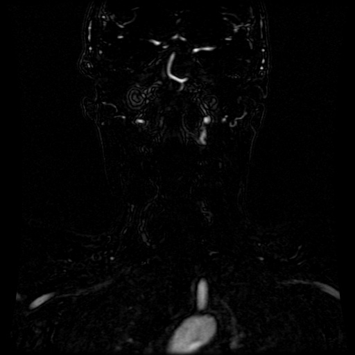 Acute internal carotid artery dissection (Radiopaedia 53541-59632 Coronal MRA 33).jpg