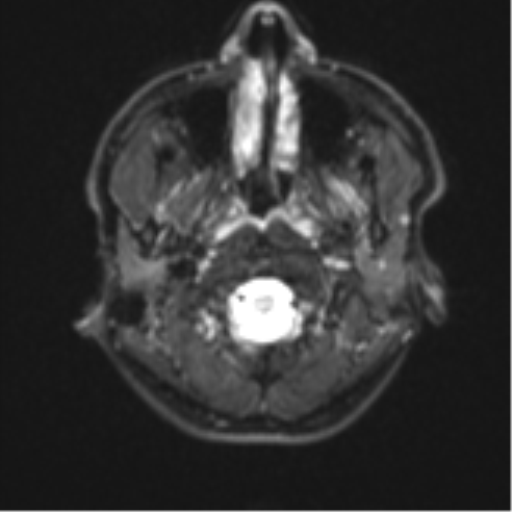 Acute left middle cerebral artery territory infarct with clot retrieval (Radiopaedia 47732-52433 Axial DWI 1).png