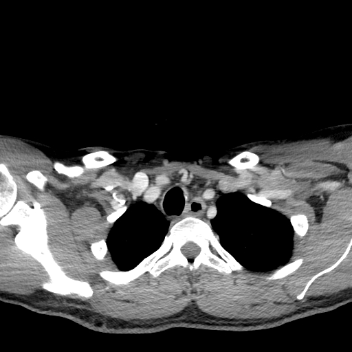 Acute longus colli calcific tendinitis (Radiopaedia 72495-83036 Axial C+ arterial phase 85).jpg