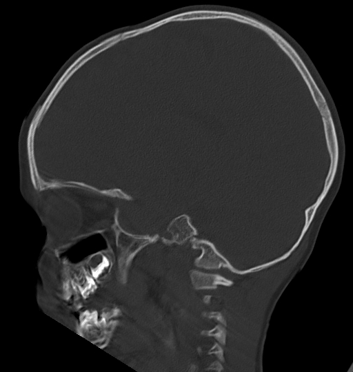 Acute mastoiditis (Radiopaedia 82678-96881 Sagittal bone window 41).jpg