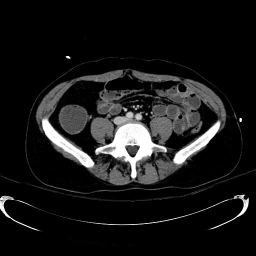 Acute myocardial infarction in CT (Radiopaedia 39947-42415 Axial C+ portal venous phase 83).jpg