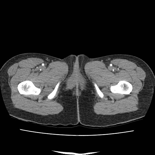 File:Acute myocarditis (Radiopaedia 55988-62613 Axial C+ portal venous phase 89).jpg