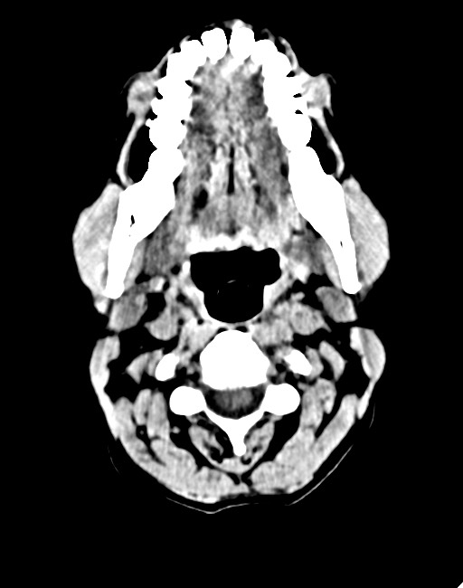 Acute on chronic subdural hematoma (Radiopaedia 74814-85823 Axial non-contrast 13).jpg