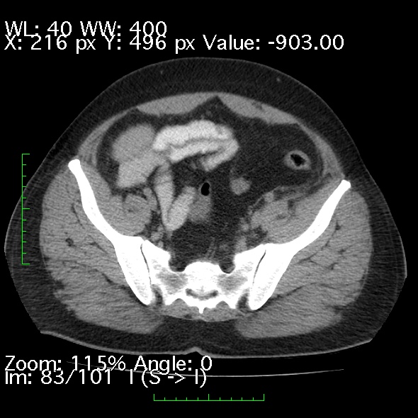 Acute pancreatitis (Radiopaedia 34043-35276 Axial non-contrast 83).jpg