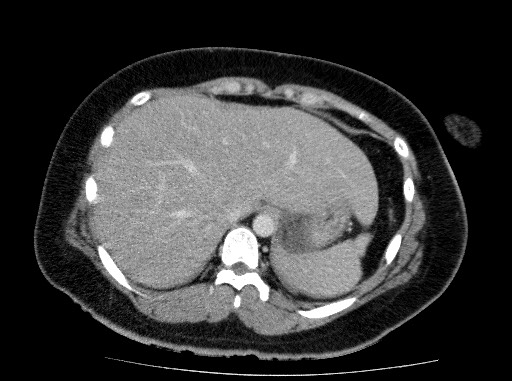 Acute pancreatitis (Radiopaedia 69236-79012 Axial C+ portal venous phase 17).jpg