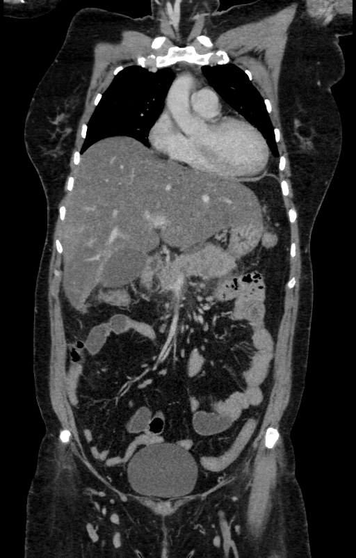 Acute pancreatitis (Radiopaedia 80007-93285 Coronal C+ portal venous phase 46).jpg