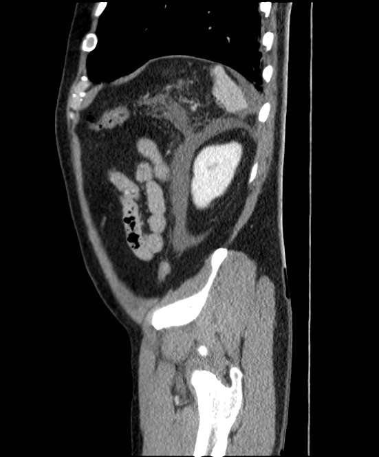 Acute pancreatitis - Balthazar E (Radiopaedia 23080-23110 Sagittal C+ portal venous phase 84).jpg